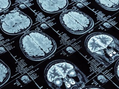 امیدی تازه برای درمان آلزایمر: محققان روشی جدید برای ارسال دارو به درون مغز پیدا کردند